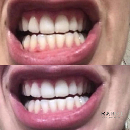 10 Tratamiento Blanqueador Dental Karbi By Blanquident