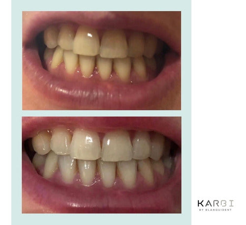 5 Tratamiento Blanqueador Dental Karbi By Blanquident