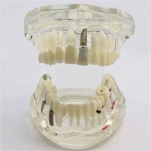 Modelo Dental Patologías-tx Tipodonto Didáctico Transparente