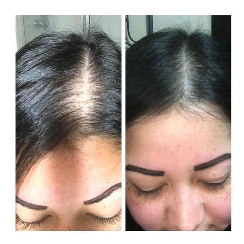 Kit Intensivo Para Alopecia Sis1:cabello Natural Poca Caídas