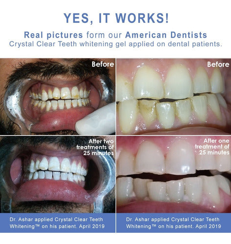 Bolígrafo De Blanqueamiento Dental Crystal Clear, 3 Uds.